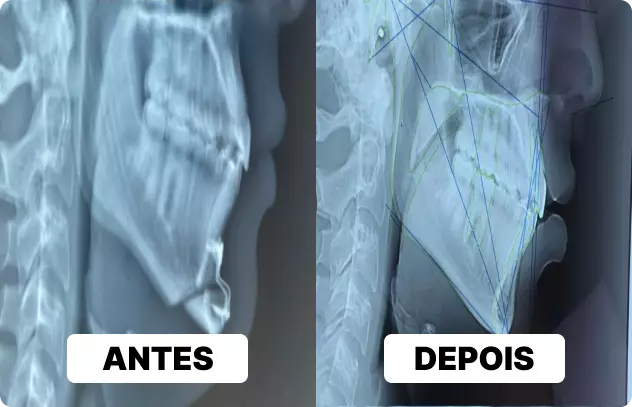 antes e depois de mentoplastia