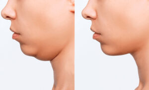 cirurgia ortognática