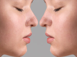 rinoplastia
