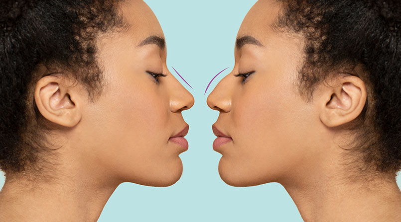 Formatos de nariz: conheça os tipos e como valorizá-los