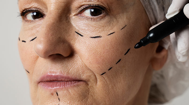 Implantes Faciais – o segredo para a harmonização facial definitiva